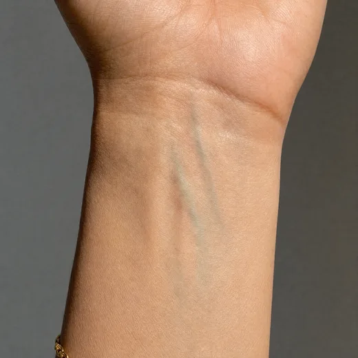 Example wrist photo showing vein color